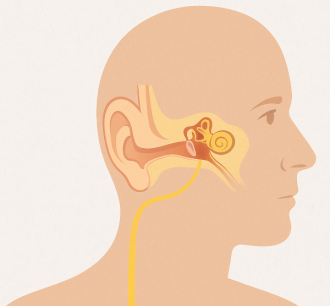 Θεραπεία των Εμβοών με Διέγερση του Πνευμονογαστρικού Νεύρου